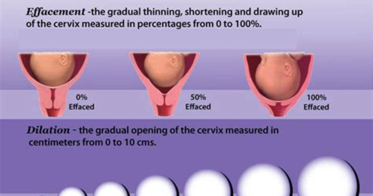 1 Cm Dilated 50 Effaced