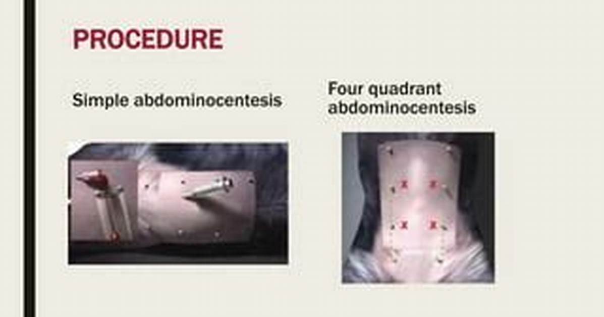 Abdominocentesis