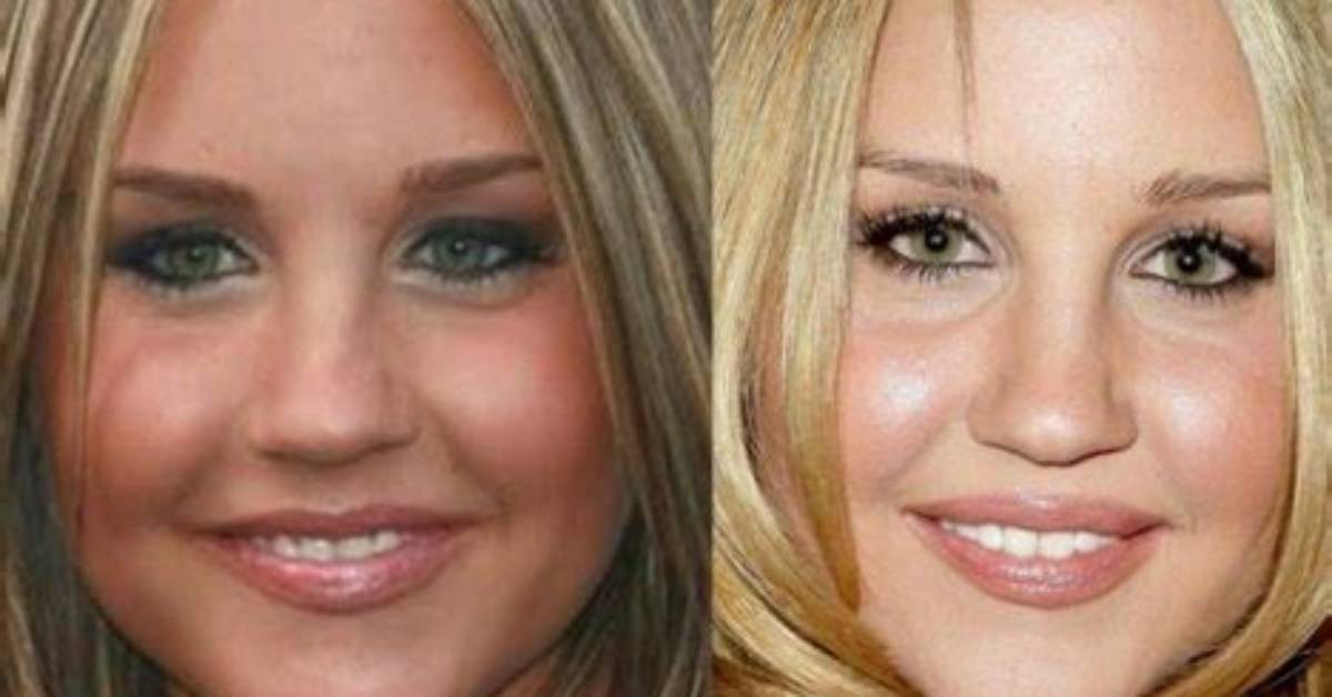 Amanda Bynes Breast Implants Plastic Surgery Before and After