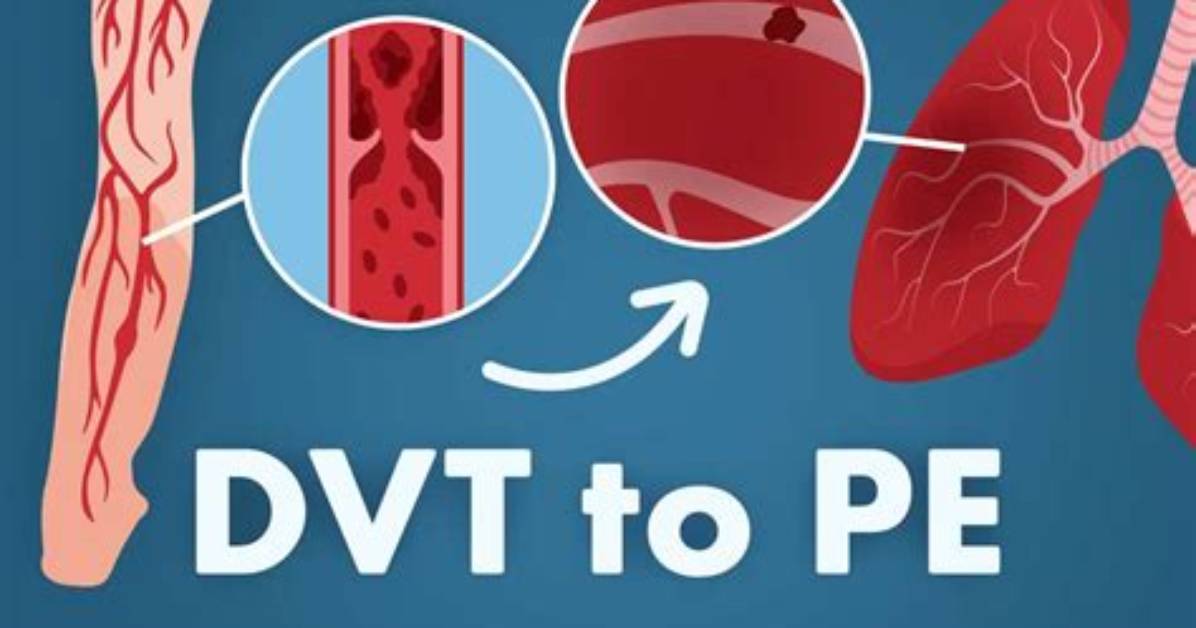 Are All Pe Caused by Dvt