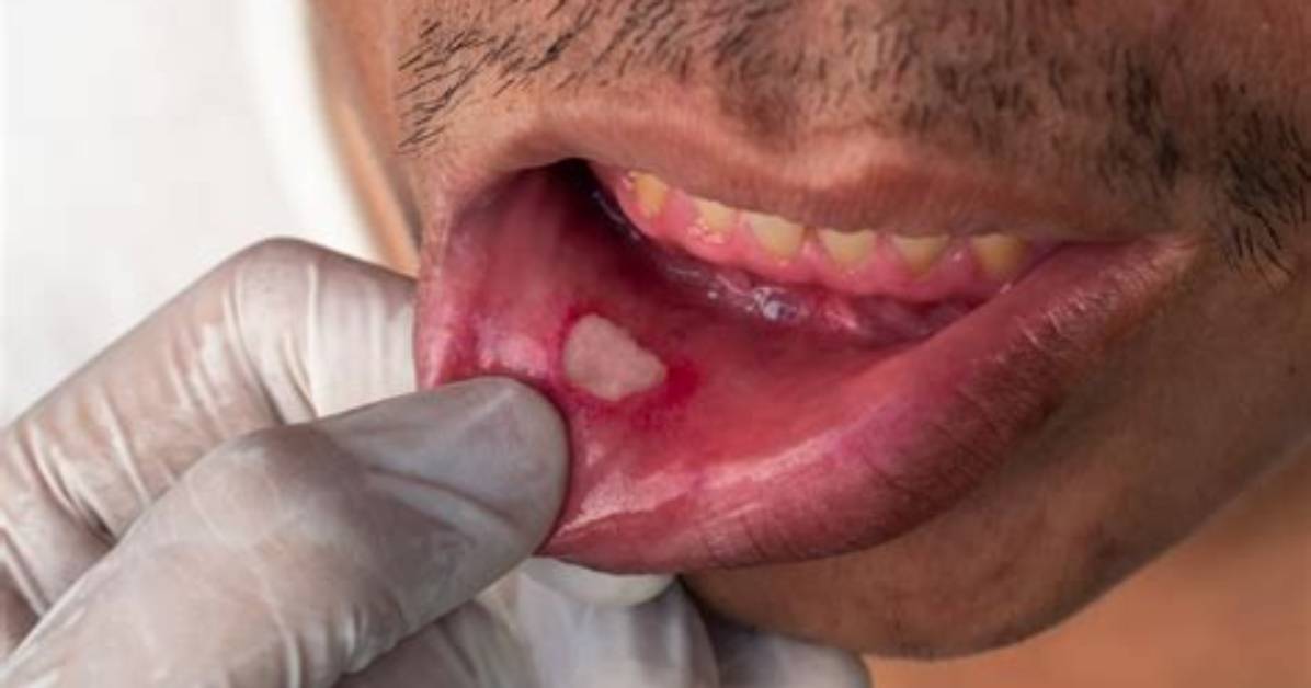 Are Aphthous Ulcers Dangerous?