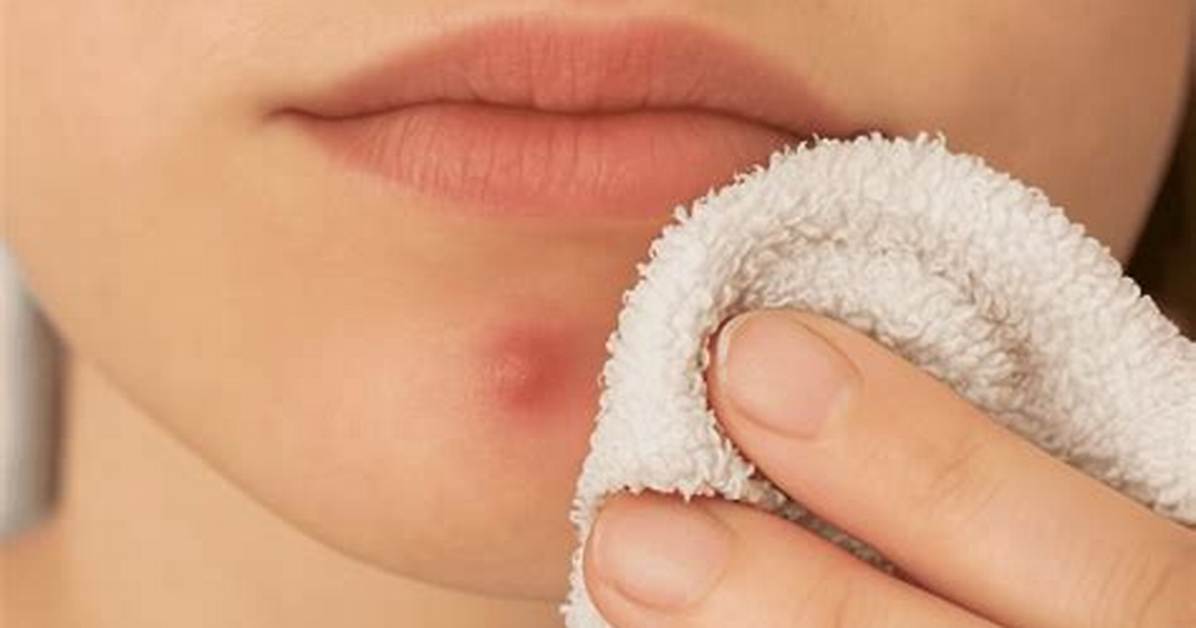 Are Blind Pimples Hormonal?
