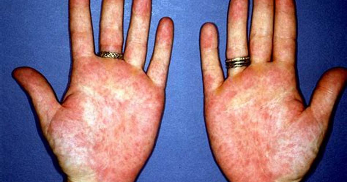 Are Blotchy Palms Normal?