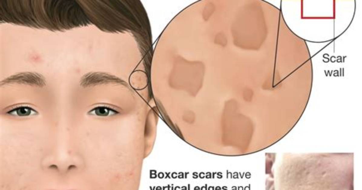 Are Boxcar Scars Permanent?