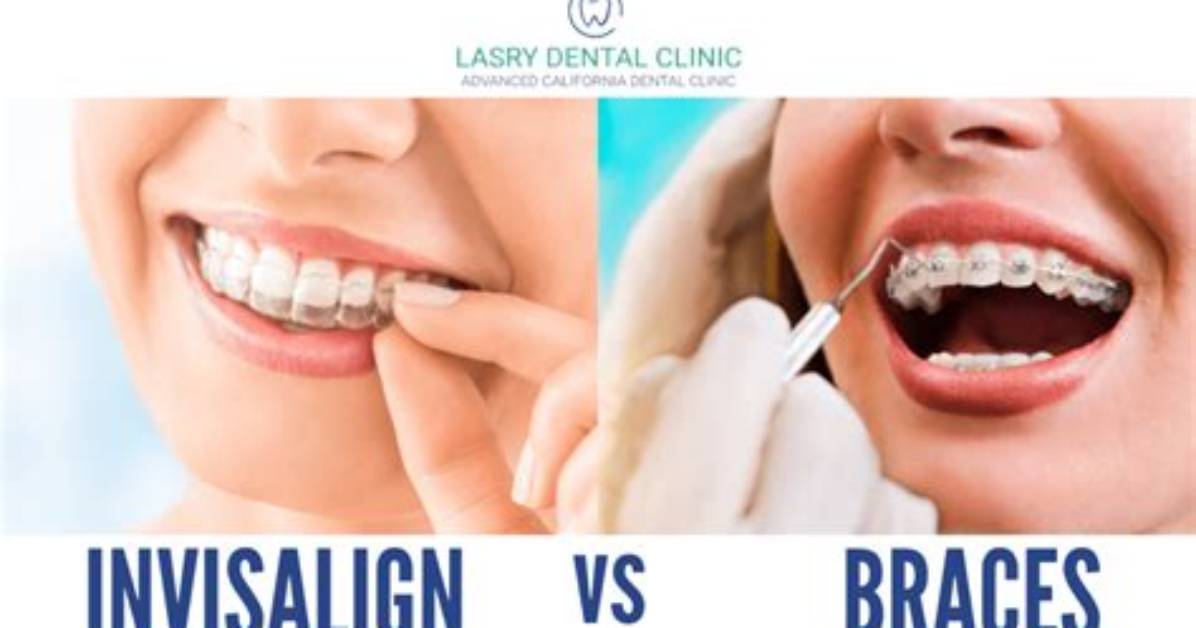 Are Braces Cheaper Than Invisalign?
