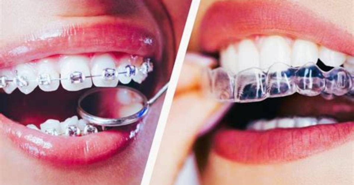 Are Braces or Invisalign Quicker?