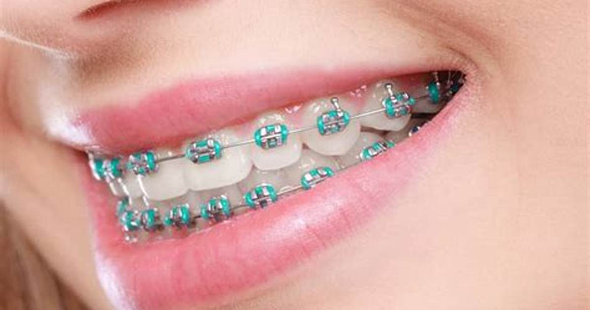 Are Braces Worth It?