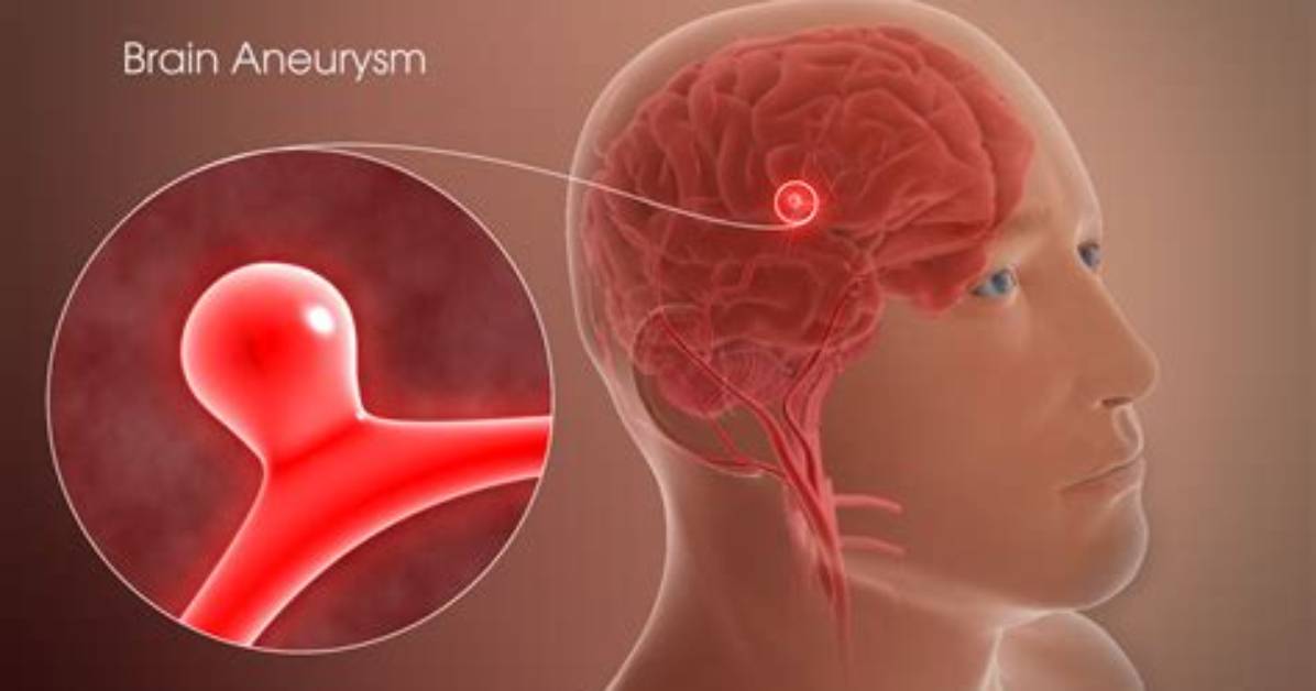 Are Brain Aneurysms Operable?