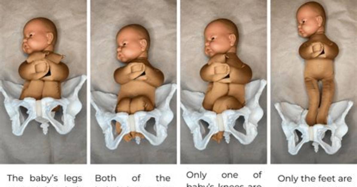 Are Breech Babies Smaller?