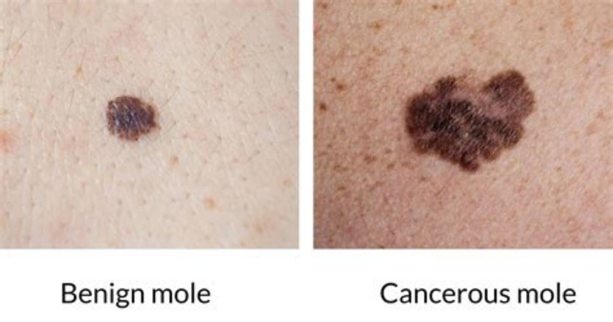 Are Bumpy Moles Cancerous?