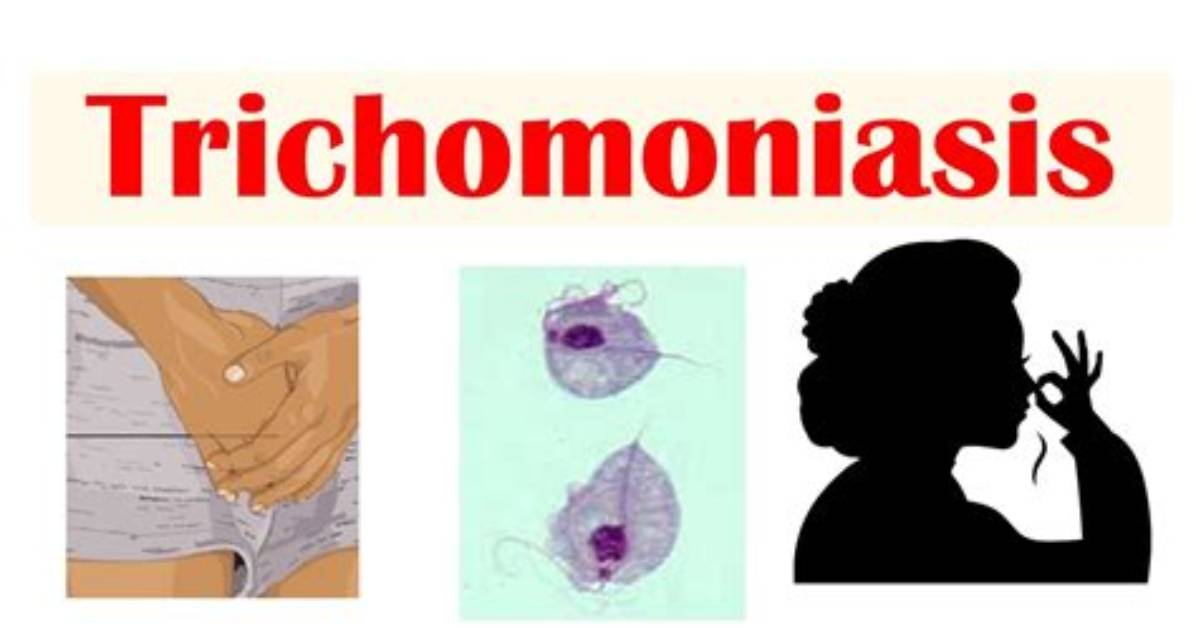 Are Chlamydia and Trichomoniasis the Same?