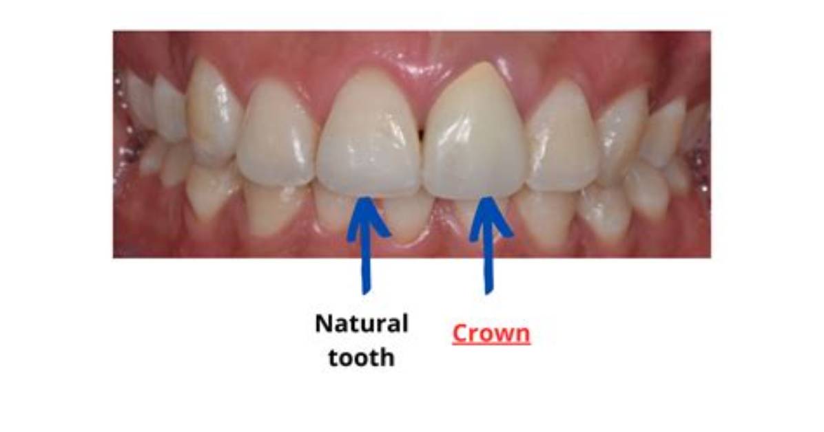 Are Crowns on Front Teeth Noticeable?