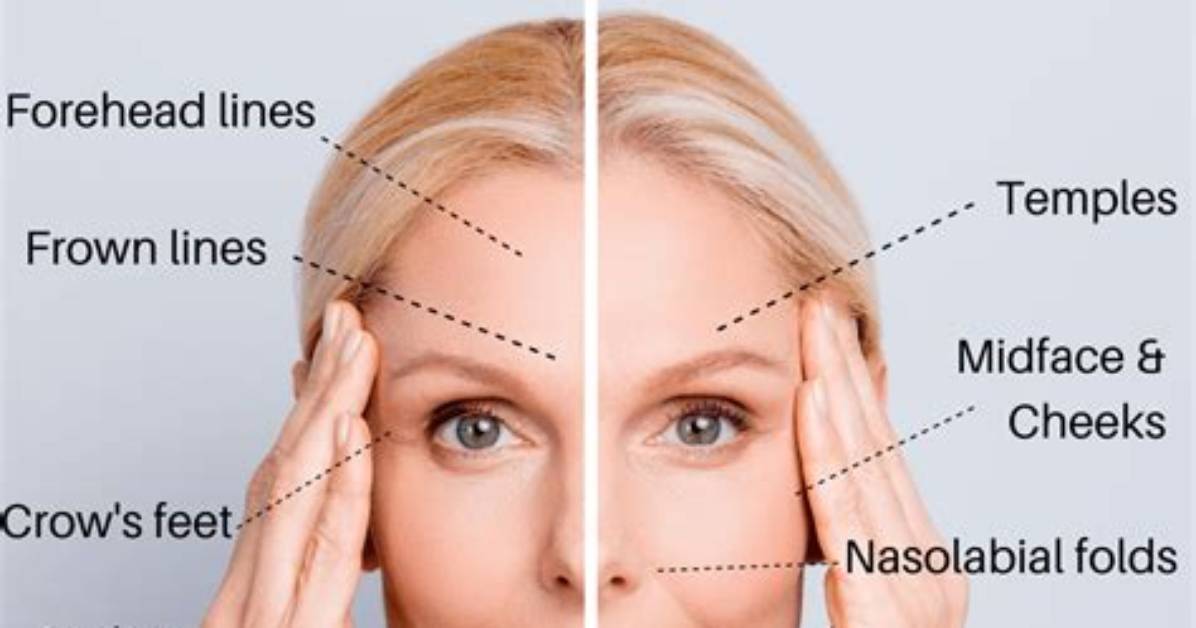 Are Dermal Fillers Botox?