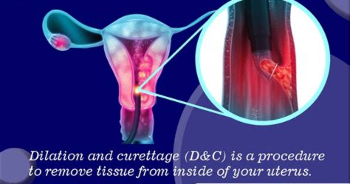 Are Dilation and Curettage Necessary?