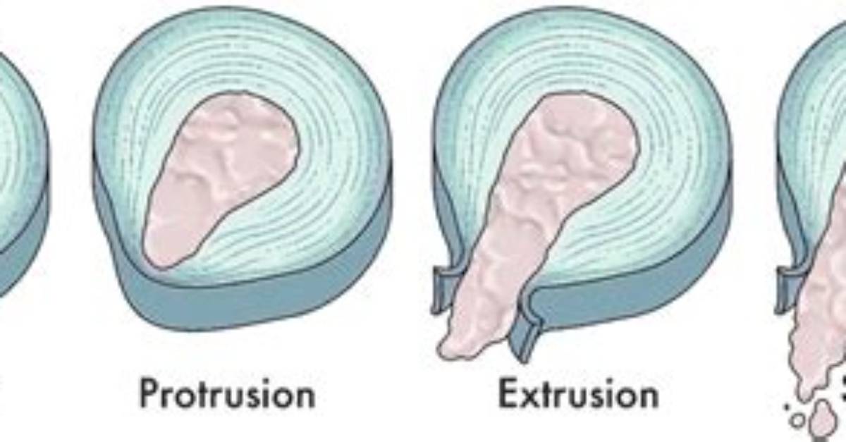 Are Disc Protrusions the Same as Herniations?