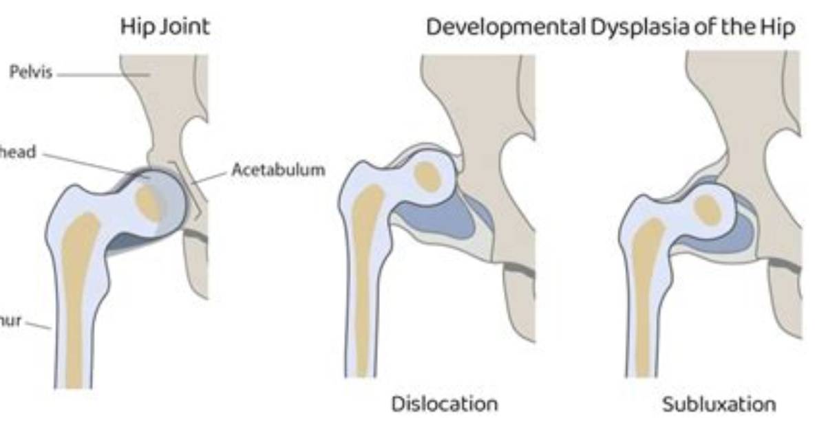 Are Dislocated Hips Hereditary?