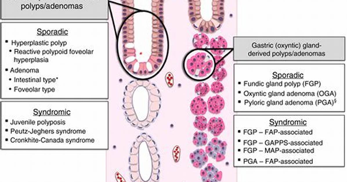 Are Duodenal Polyps Common?