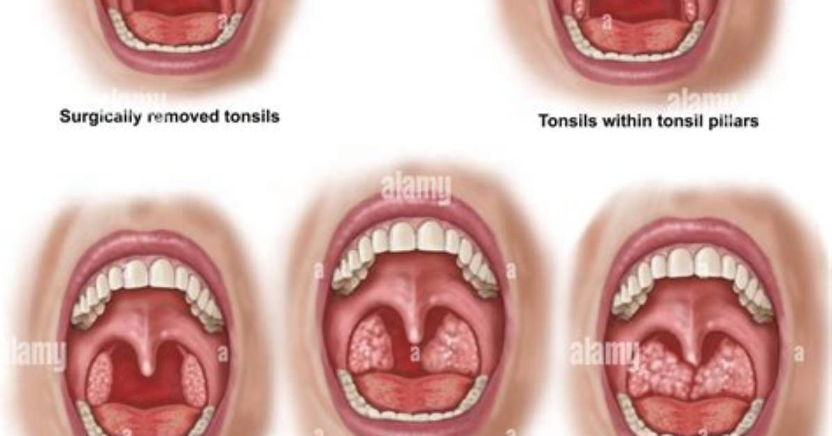 Are Enlarged Tonsils Dangerous?
