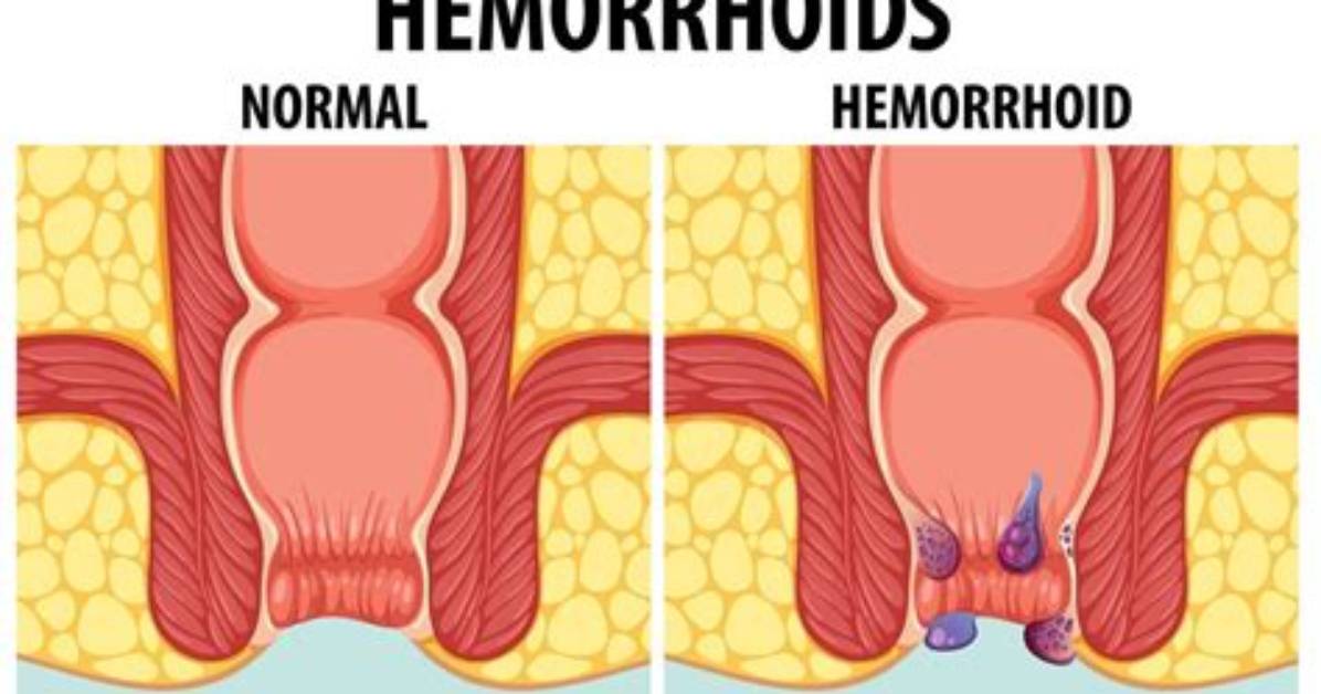 Are External Hemorrhoids Permanent?