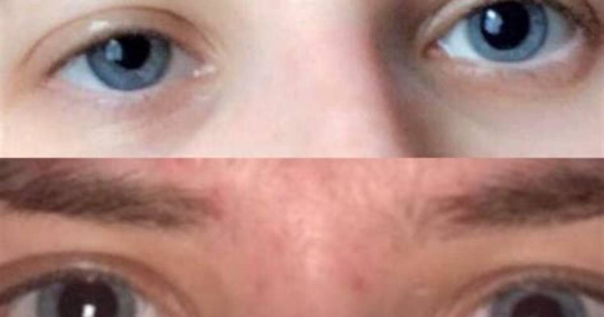 Are Eyes Two Different Sizes?