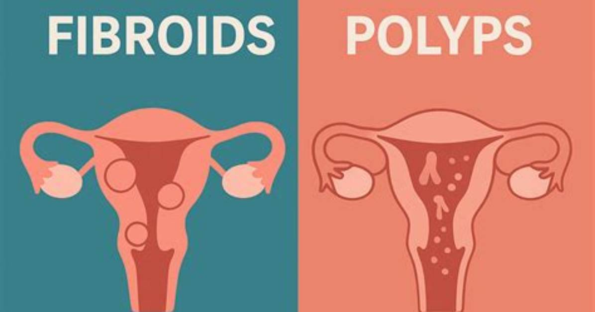 Are Fibroids and Polyps the Same?