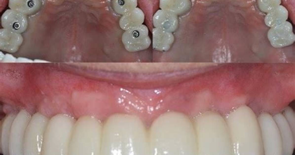 Are Full Mouth Dental Implants Worth It?