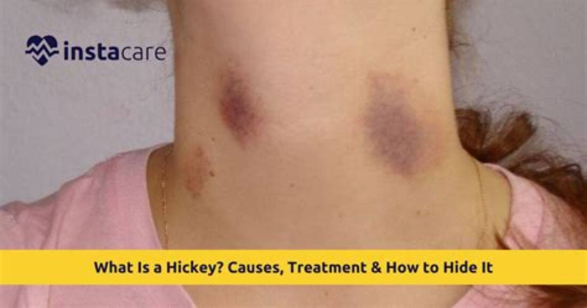 Are Hickeys a Sin?