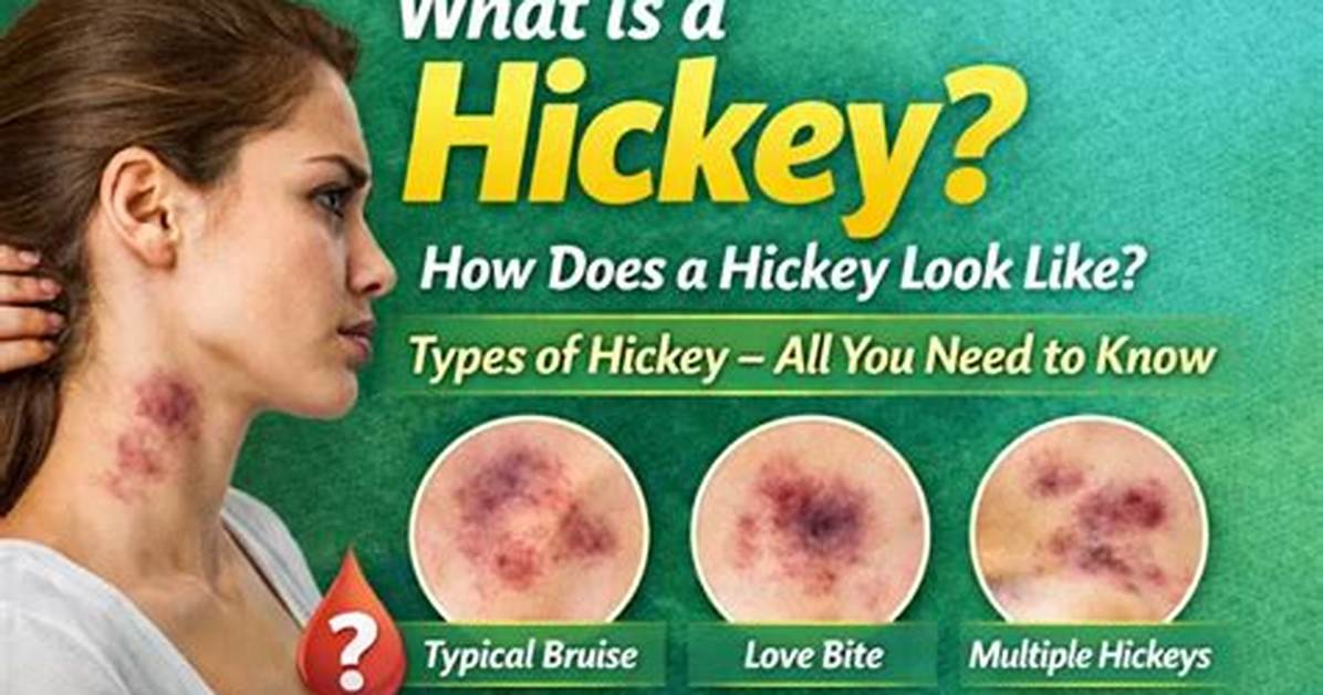 Are Hickeys Gross?