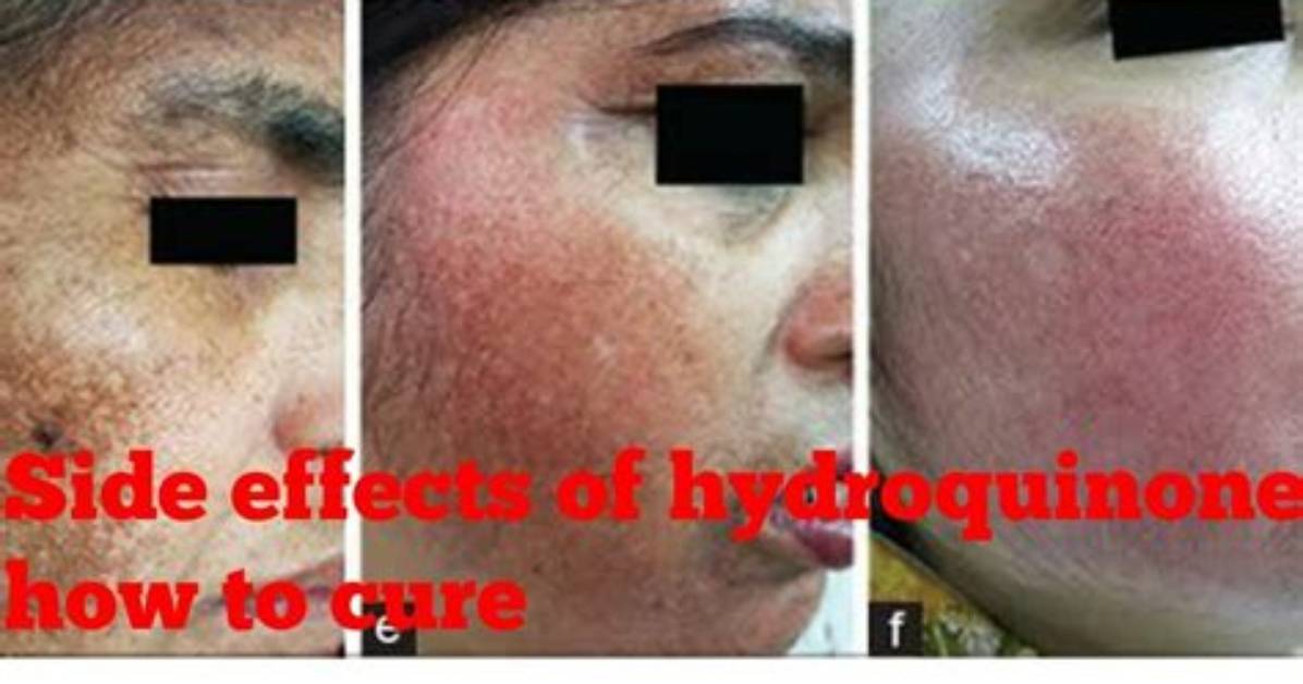 Are Hydroquinone Effects Permanent?