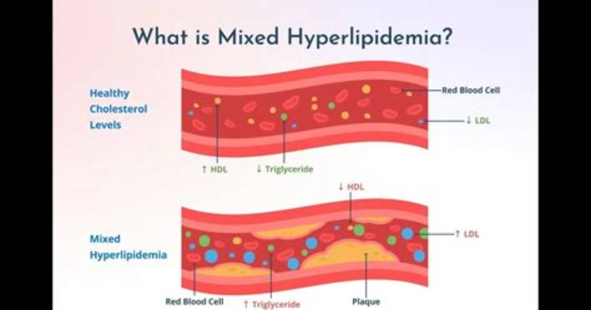 Are Hyperlipidemia and Hyperlipoproteinemia Same?
