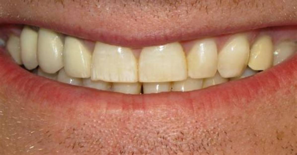 Are Normal Teeth Yellow?