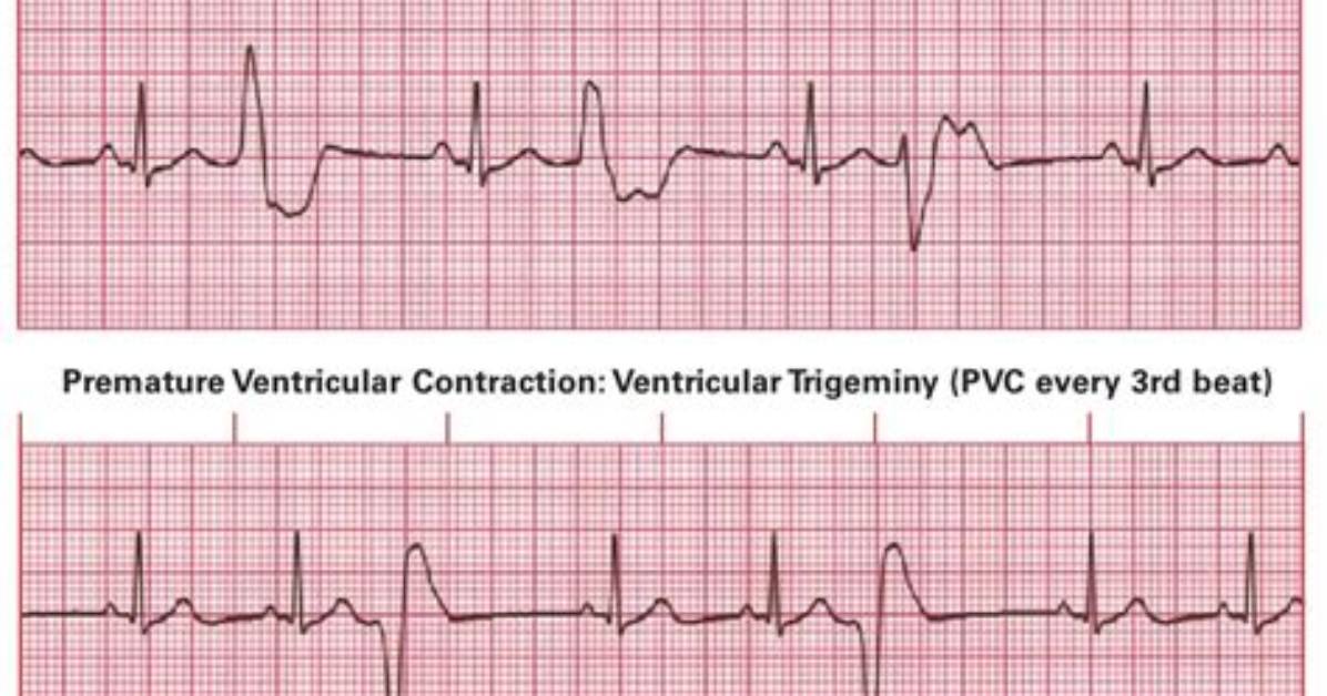Are Occasional Pvcs Normal?