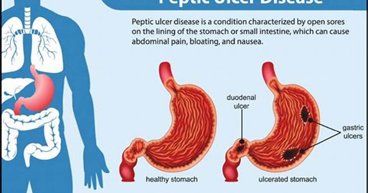 Are Peptic Ulcers Common?