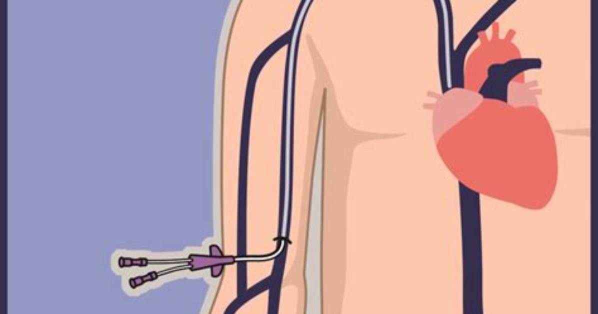 Are Picc Lines Dangerous?