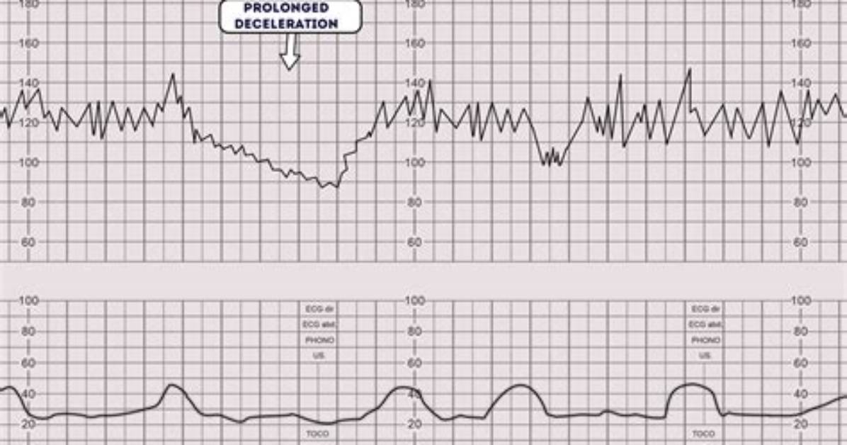 Are Prolonged Decelerations Bad?