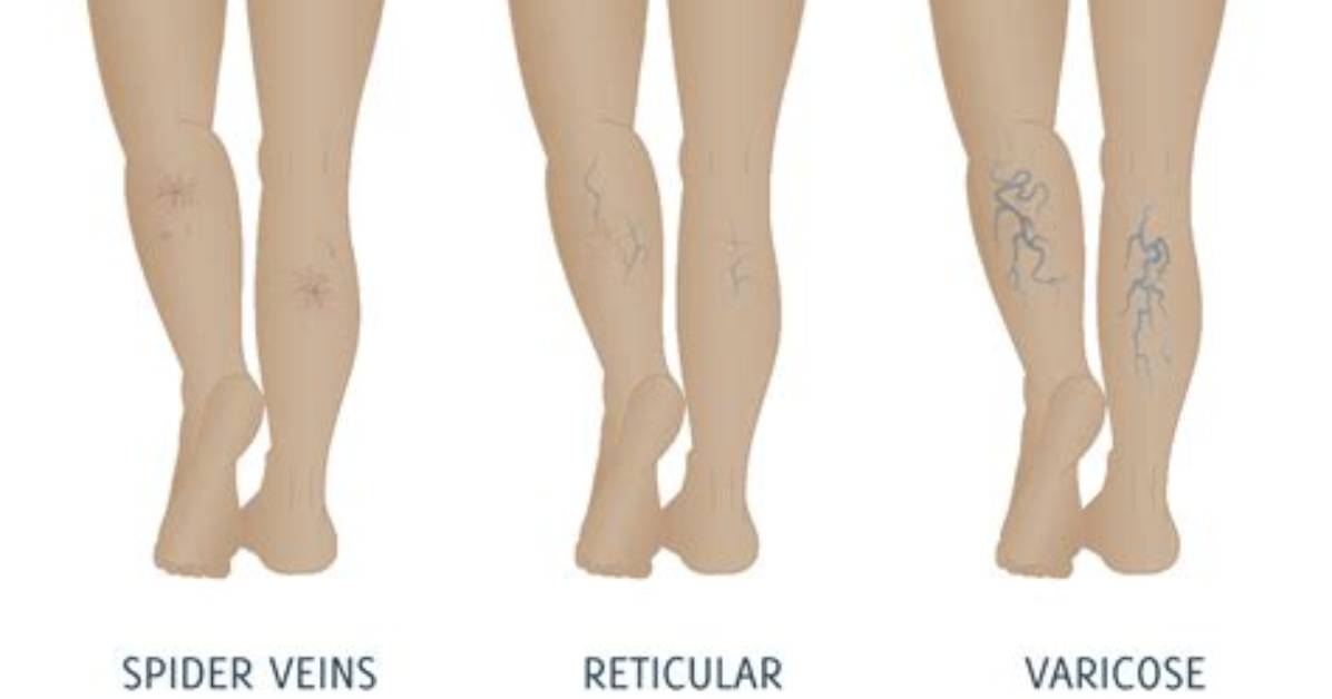 Are Reticular Veins Normal