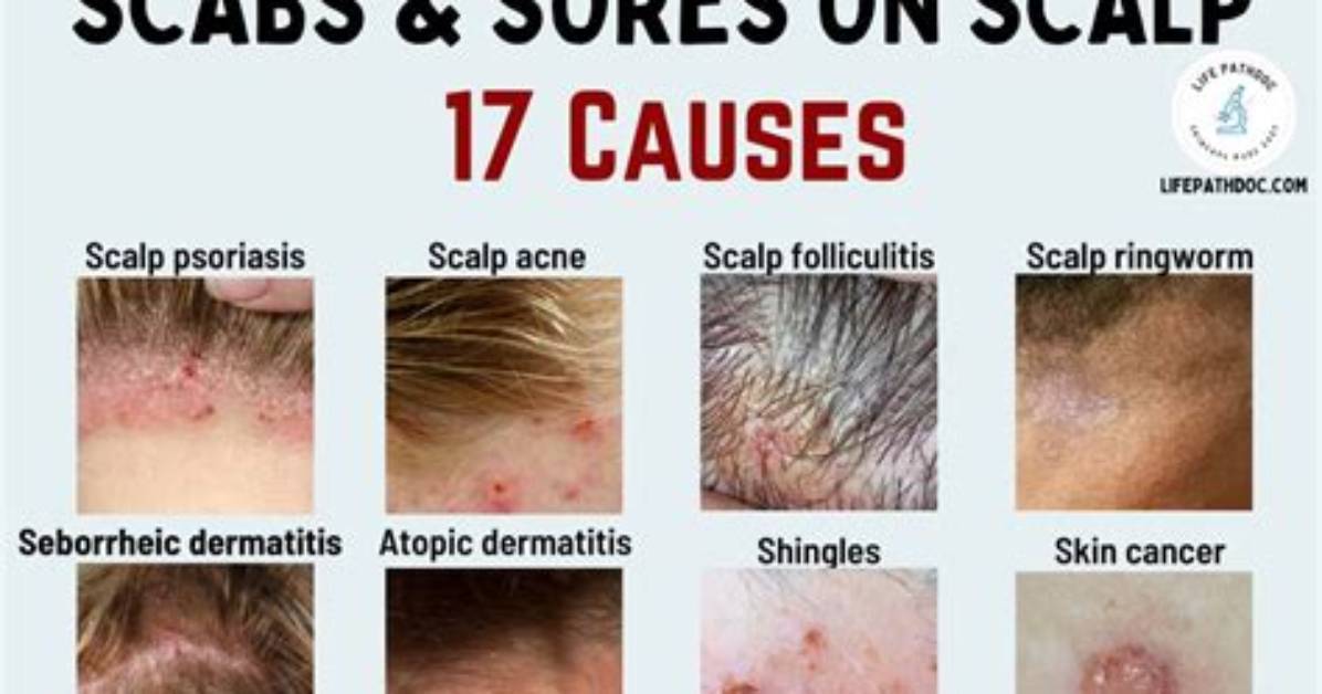Are Scabs Bad