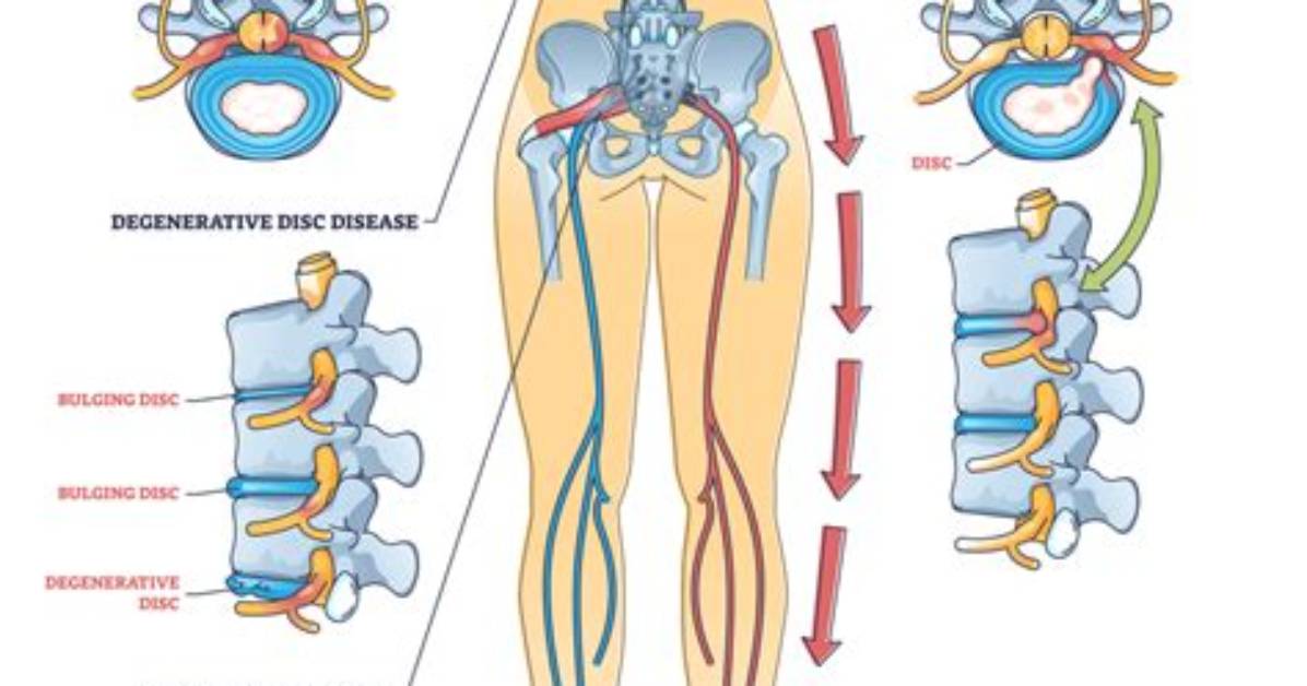 Are Sciatica and Bursitis Related?