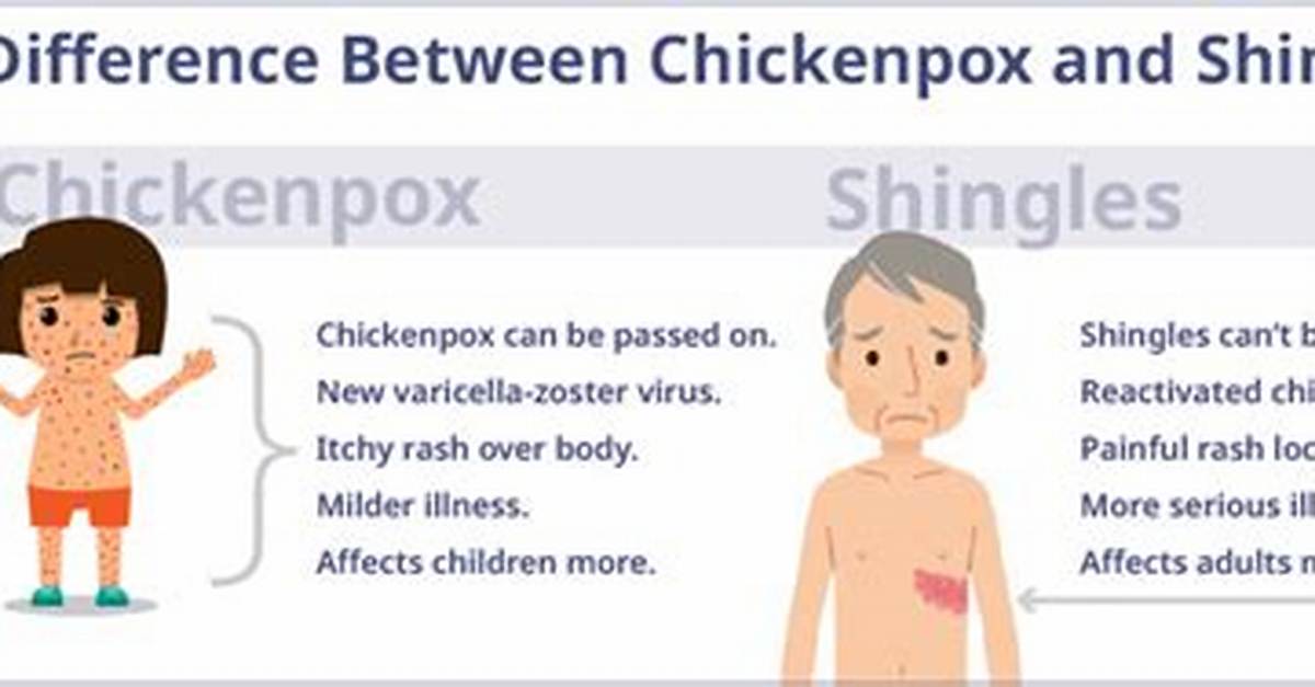Are Shingles the Same as Chicken Pox?
