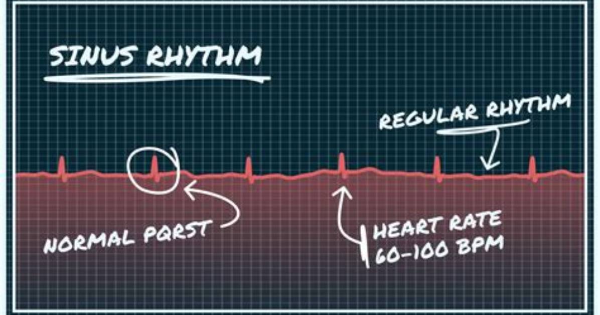Are Sinus Rhythm Bad?