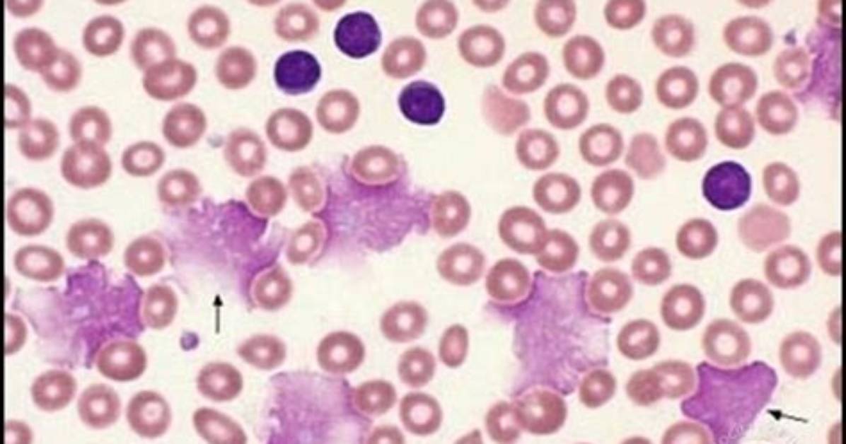 Are Smudge Cells Ever Normal