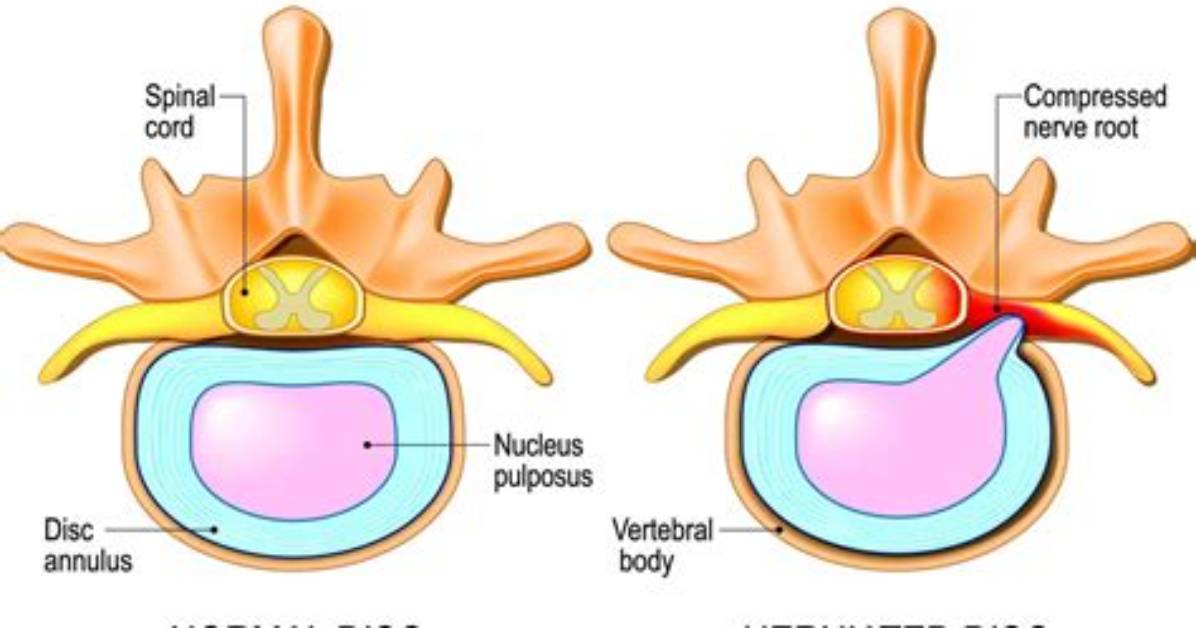 Are Spinal Discs Cartilage