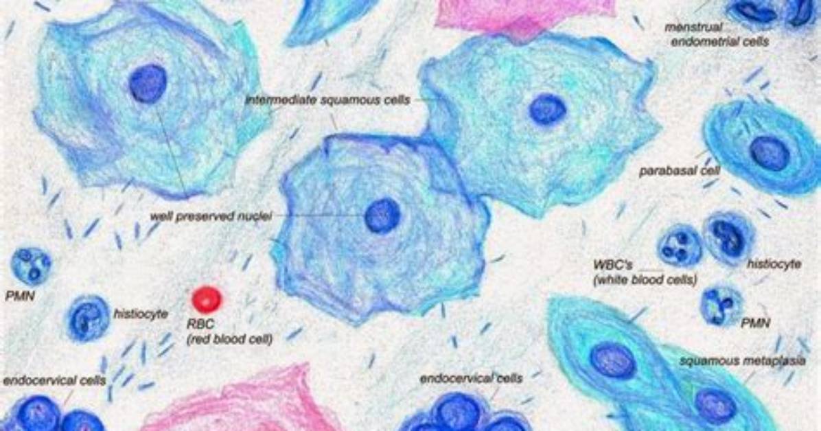 Are Squamous Metaplastic Cells Normal?
