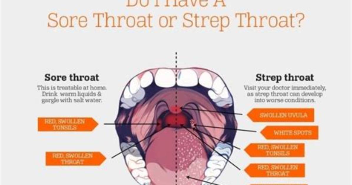 Are Strep Throat Contagious?