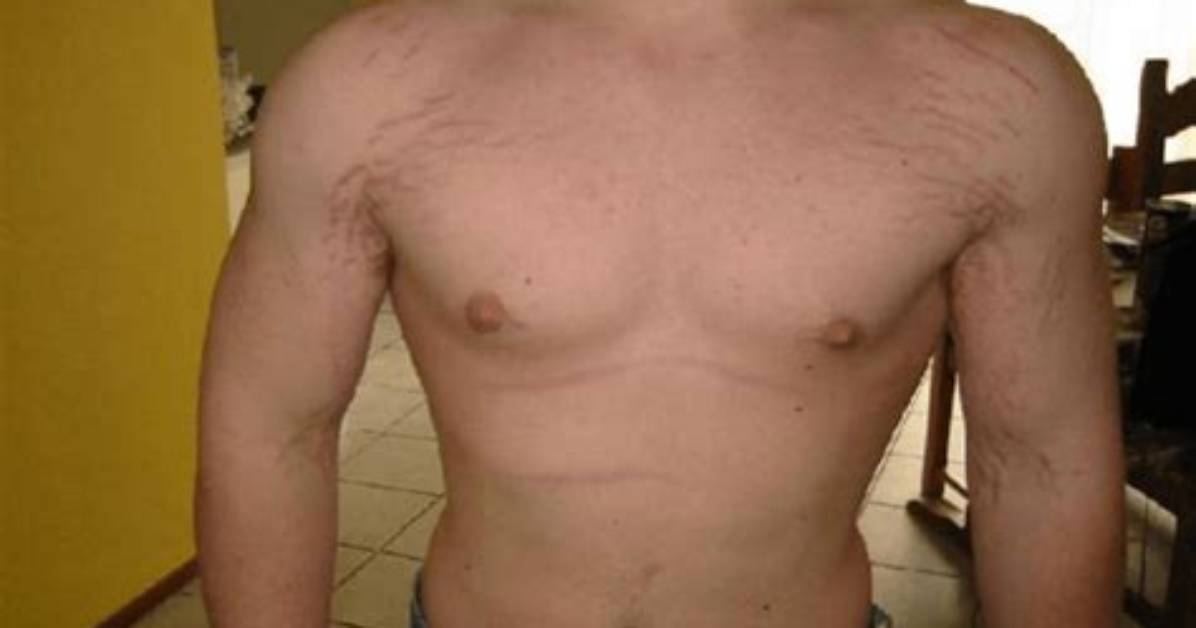 Are Stretch Marks from Working out Bad?