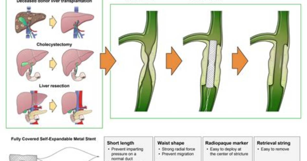 Are Stricture and Stenosis the Same Thing?