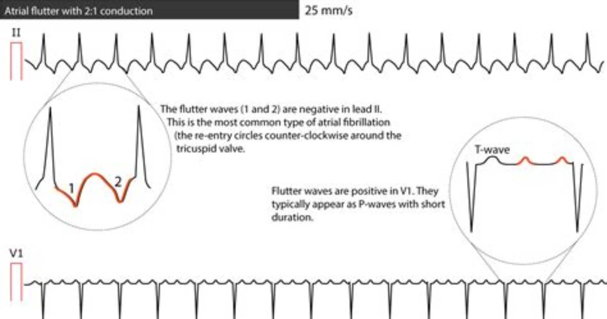 Are There P Waves in a Flutter?