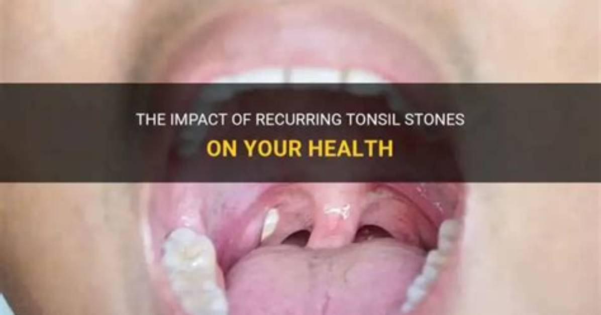 Are Tonsil Stones Recurring?