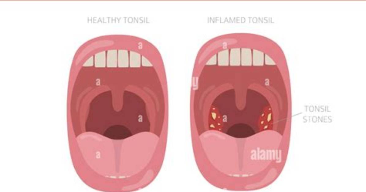 Are Tonsil Stones Tonsillitis?