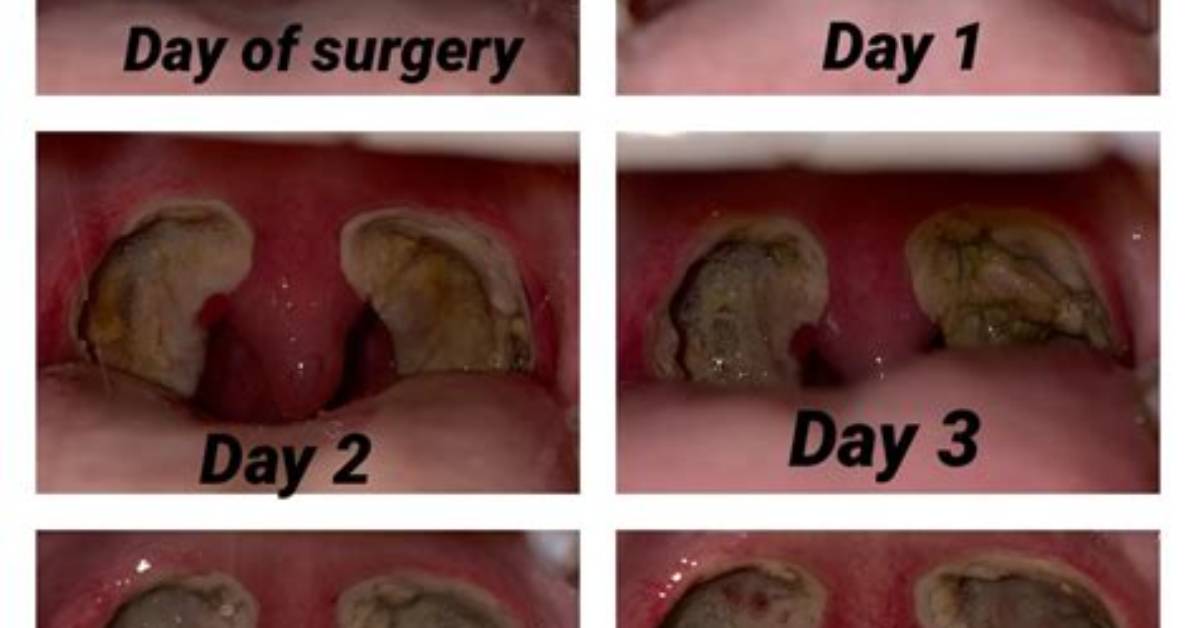 Are Tonsillectomy Scabs White?